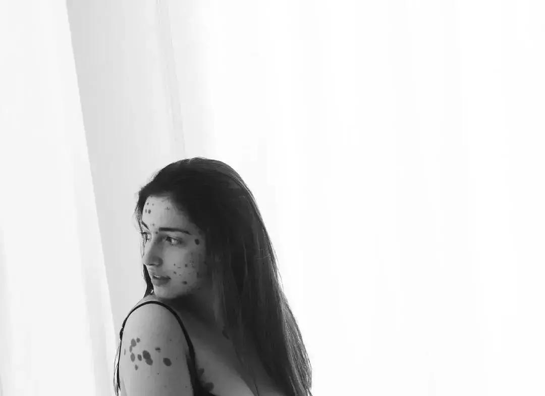 全身黑斑被骂“斑点狗”，身高160的她却成为最美超模…