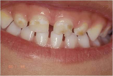 关于宝宝出牙如何护理,宝宝牙齿出牙后怎么护理