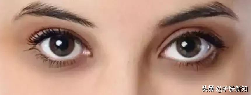 太有才了，竟然有人拿痔疮膏治疗黑眼圈