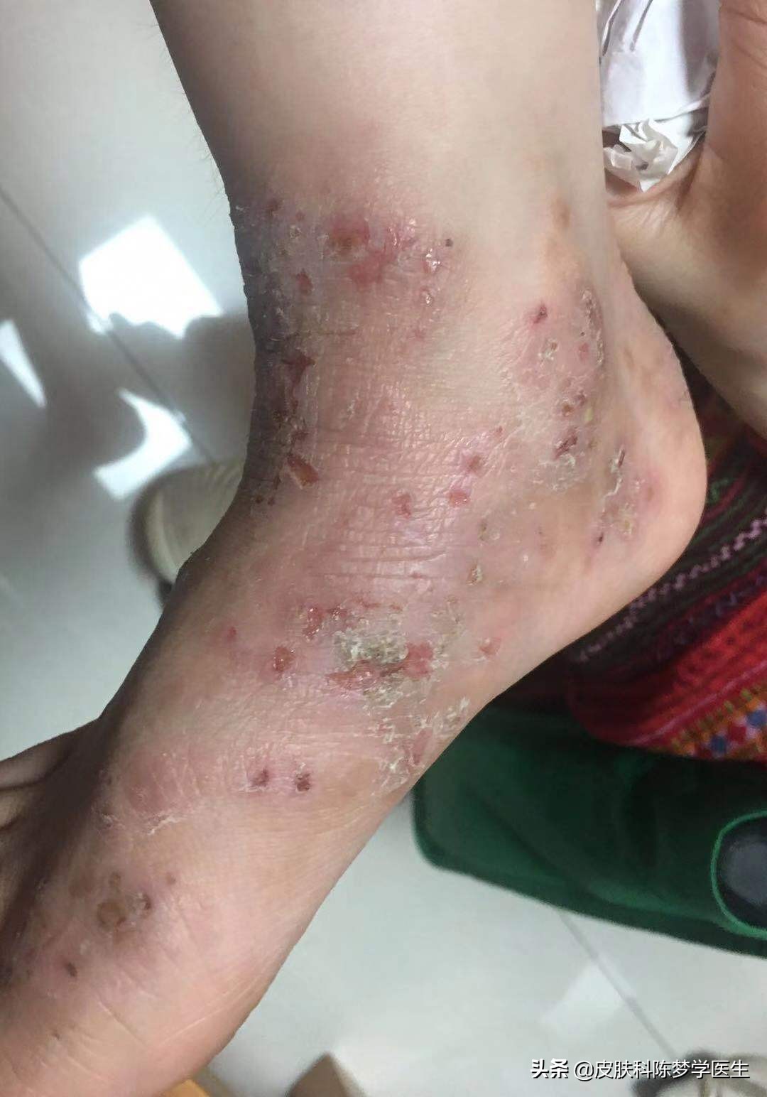 藿香正气水治湿疹,马齿苋煮水治湿疹