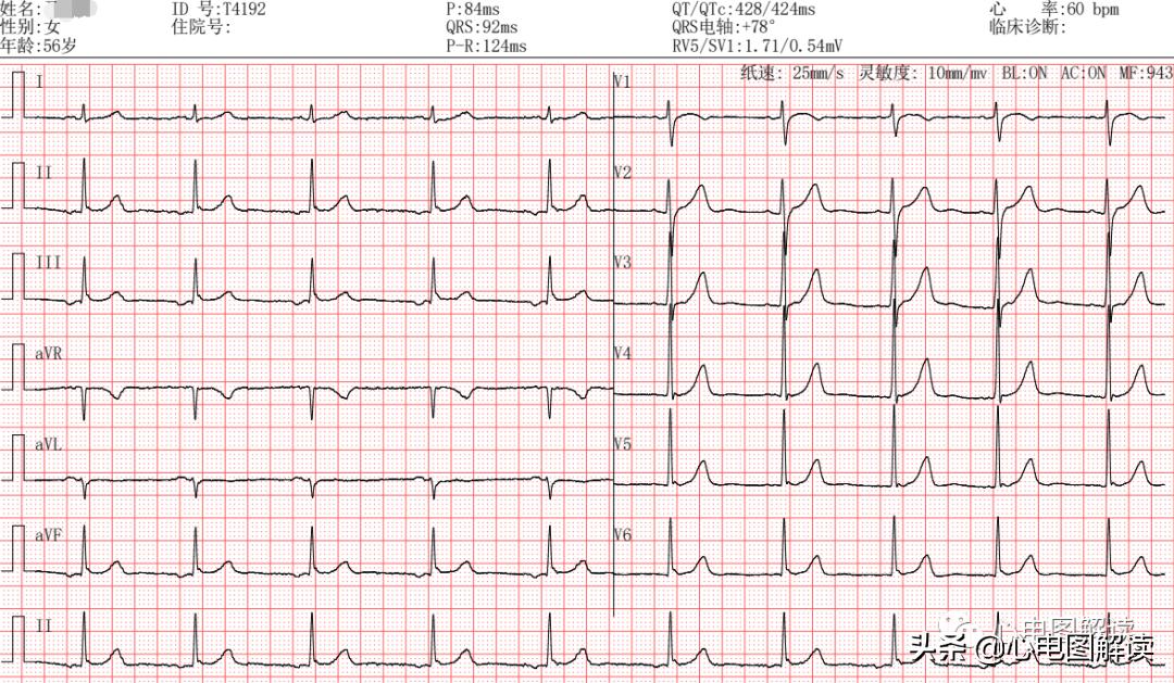 心房下部游走性心律什么意思,心房到窦房结游走性心律什么意思