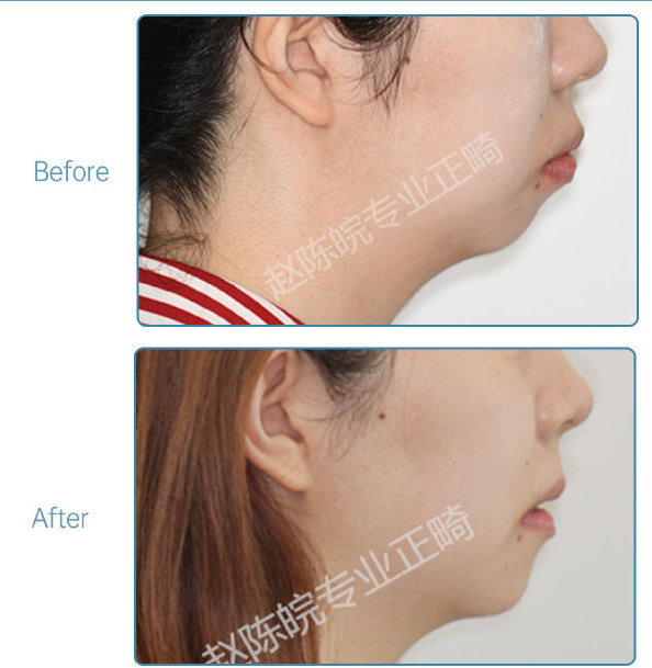 杭州牙齿矫正的全过程,杭州牙齿矫正哪个医生最好