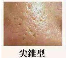 比激光更有效的祛痘坑方法,痘痘痘坑怎么消除