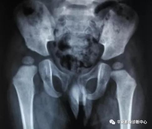 儿科先天性髋关节脱位的分型为,先天性髋关节脱位分级