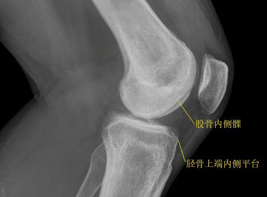 后交叉韧带损伤分什么情况,膝关节前交叉韧带损伤