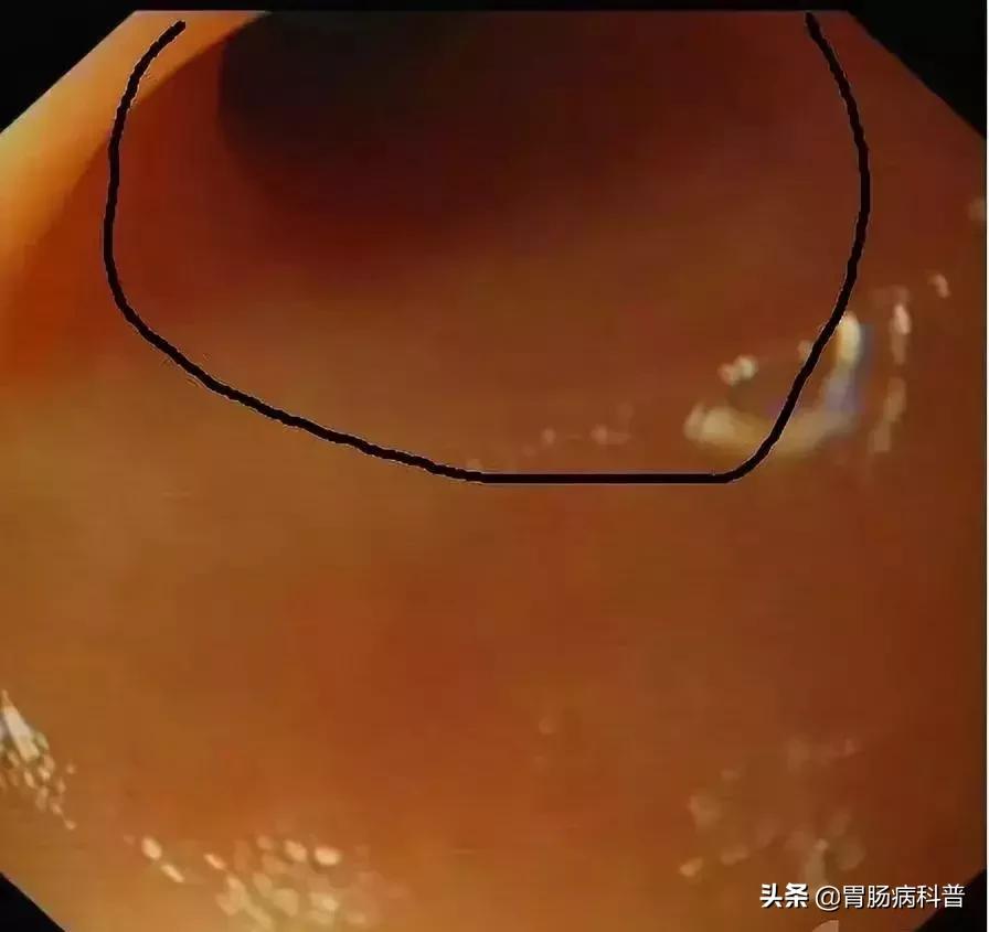 阑尾炎最新内镜微创手术,内镜下阑尾炎治疗术哪里可以做