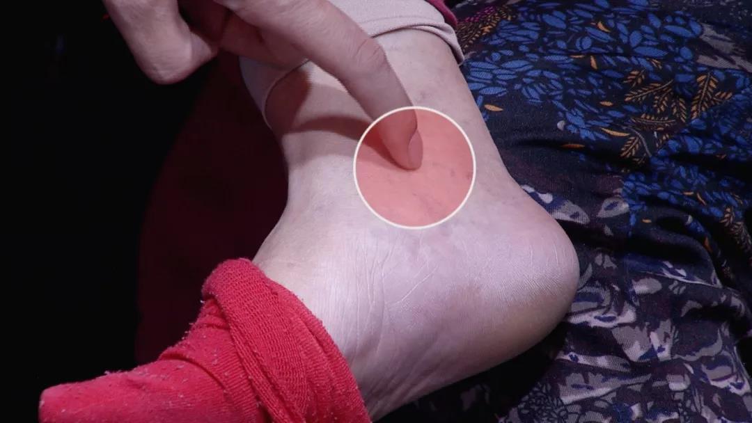 点穴调理失眠的方法,点穴治失眠三个穴位助你入睡