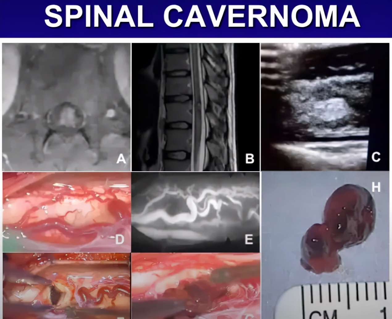 颅内海绵状血管瘤能治好吗,什么是颅内海绵状血管瘤