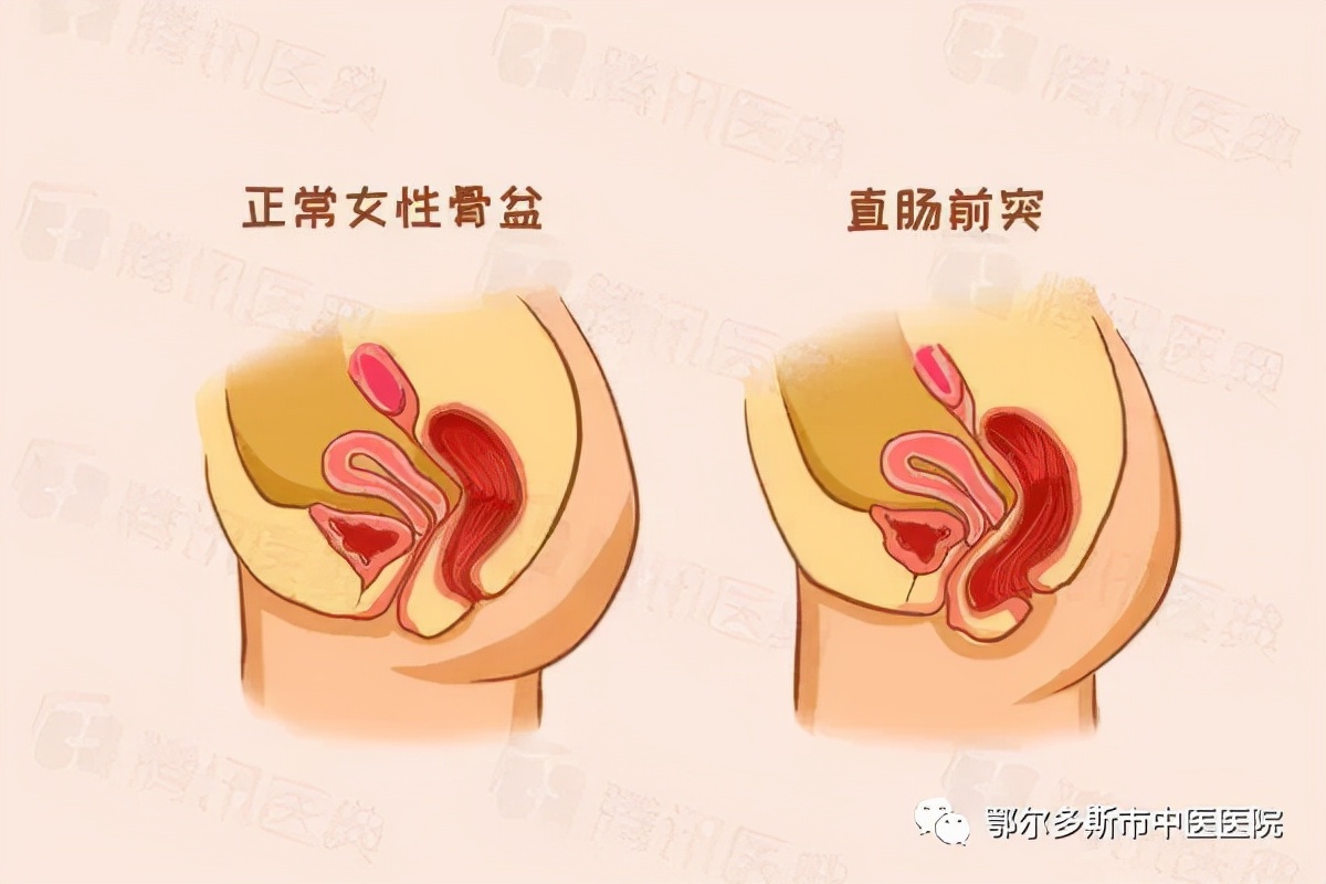 去中医院看便秘哪个大夫好,中医便秘门诊病历范文100篇