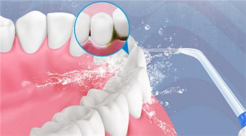 可视超声波冲牙器,可视冲牙器有哪几个牌子