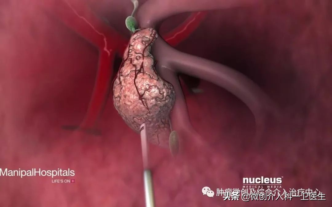 运城市第一医院肿瘤手术,运城市第一医院微创介入手术