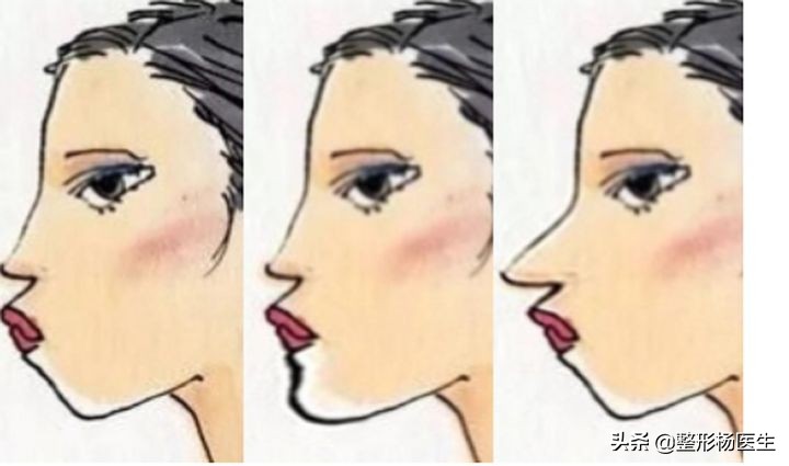 改变脸型除了削骨还有其他办法吗,国字脸磨骨成瓜子脸