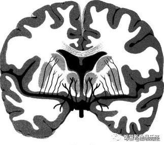 腔隙性脑梗死需住院治疗吗,腔隙性脑梗死需要住院治疗吗