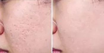 月球表面的痘坑能去掉吗,像毛孔一样的痘坑怎么修复