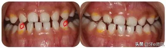 乳牙地包天会自动好吗,乳牙地包天矫正活动器