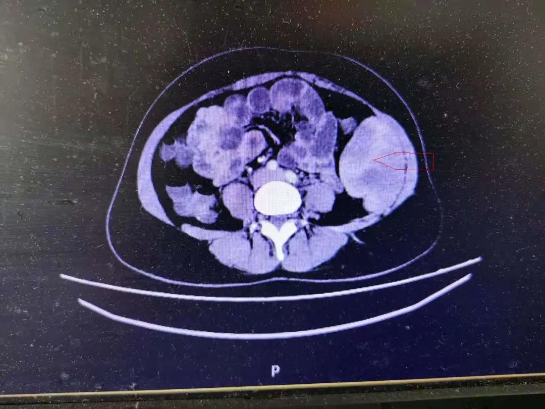 微创手术切除肠道肿瘤,中心医院切胃手术