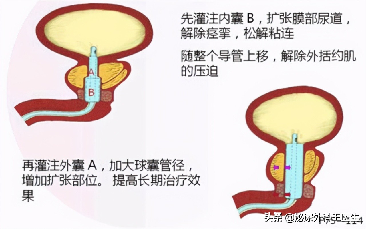 老年人怎样预防前列腺增生,预防前列腺增生最佳锻炼操