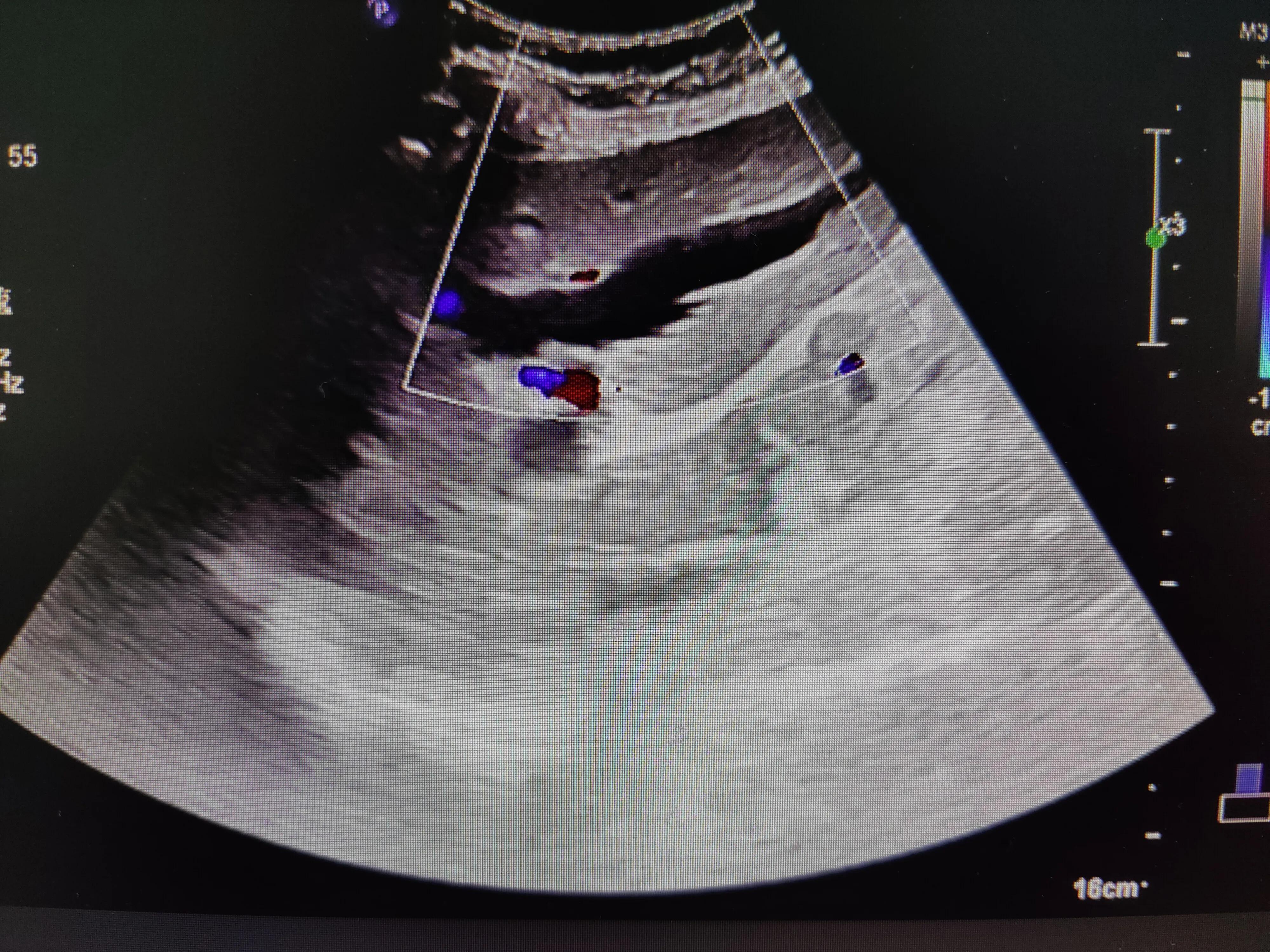 胰腺癌病人后期要注意些什么,胰腺癌没转移切除可以长期生存吗