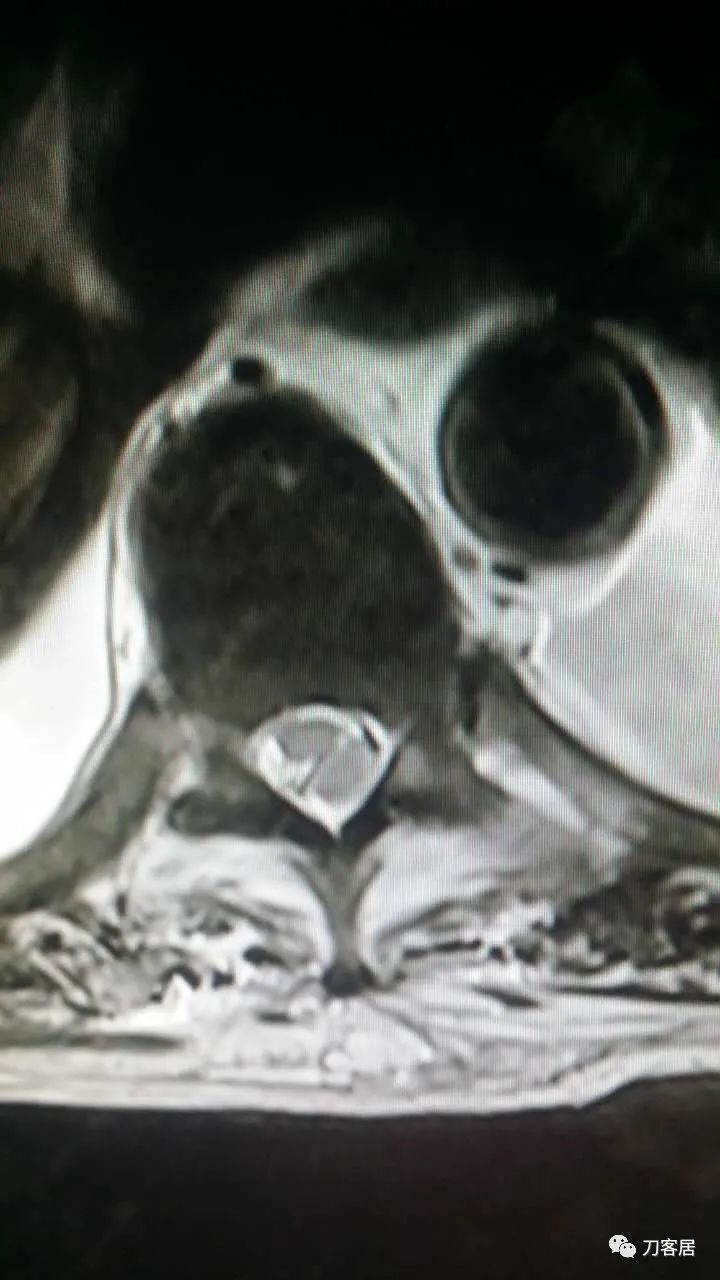 腰椎手术切掉棘突,腰突微创后出血肿
