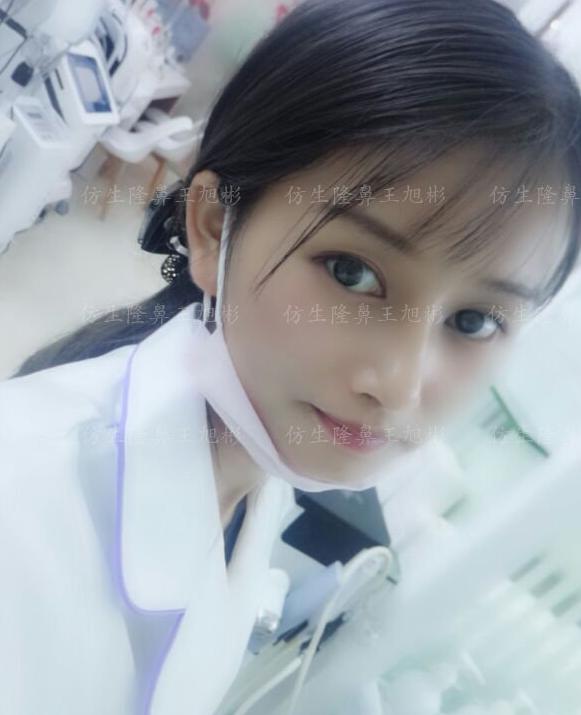 山根低鼻头大隆鼻,鼻根很低的隆鼻后的效果