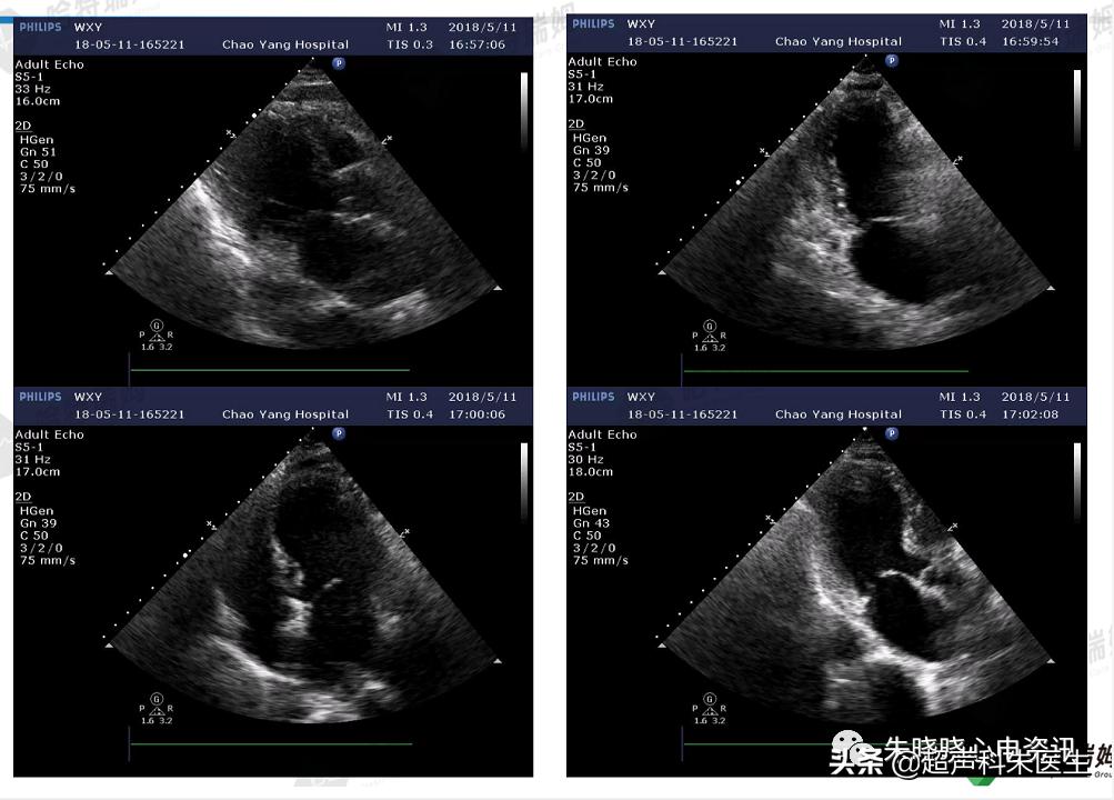 t波倒置诊断,t波倒置如何区分严重程度