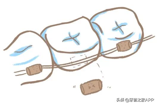 疫情时牙套遇到突发情况怎么办？应对办法在这里