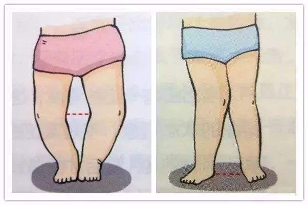 新生儿小腿弯曲多久才会长直,新生儿的小腿弯