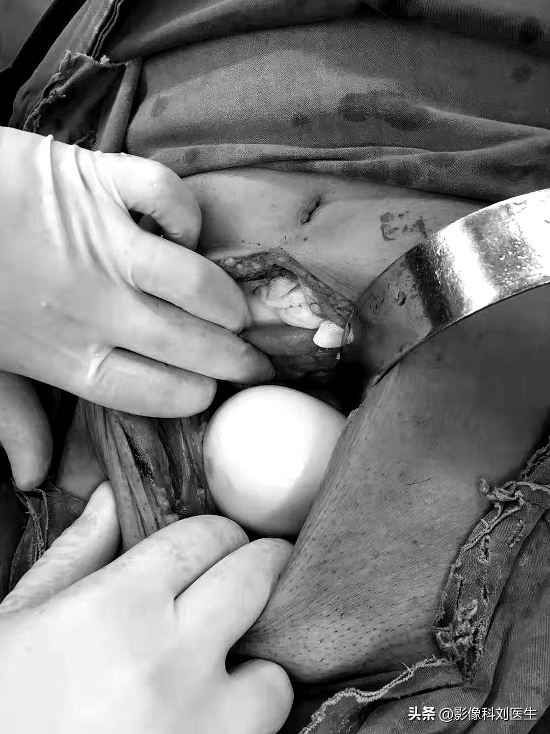 88岁的老大爷肚子痛是怎么回事,88岁大爷肚子痛