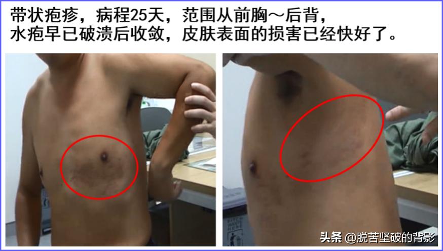 带状疱疹后遗症神经痛的手术,带状疱疹后遗神经痛放血有效吗