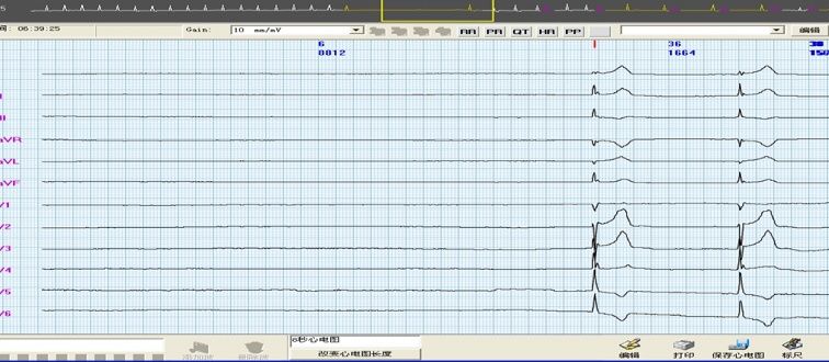 心脏起搏器能治疗心率过快吗,心脏起搏器会突然休克吗
