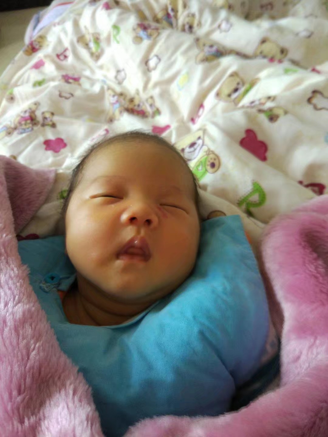 宝宝血管瘤治愈,血管瘤宝宝治疗