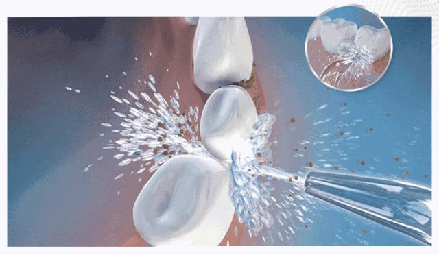 洗牙去除异物吗,洗牙怎样才不伤牙齿