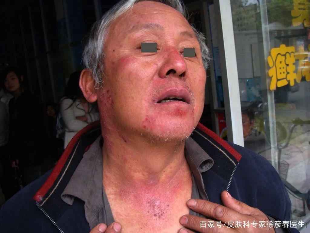 抗衰老的原因和解决方法,慢性衰老怎么办