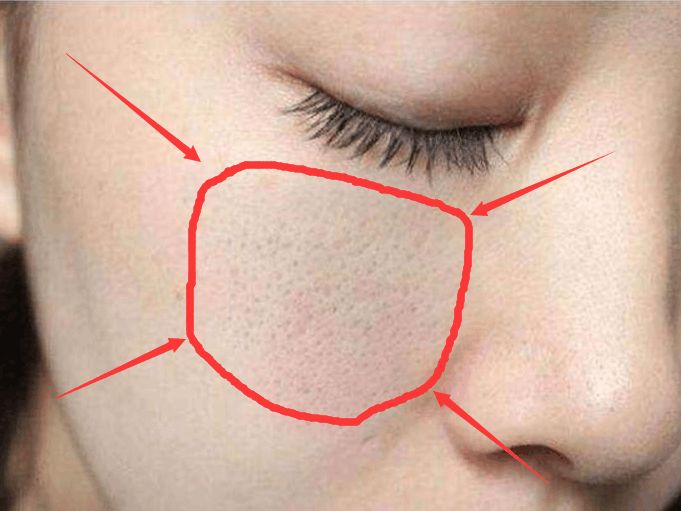 毛孔黑头小妙招,怎么改善毛孔粗大黑头闭口