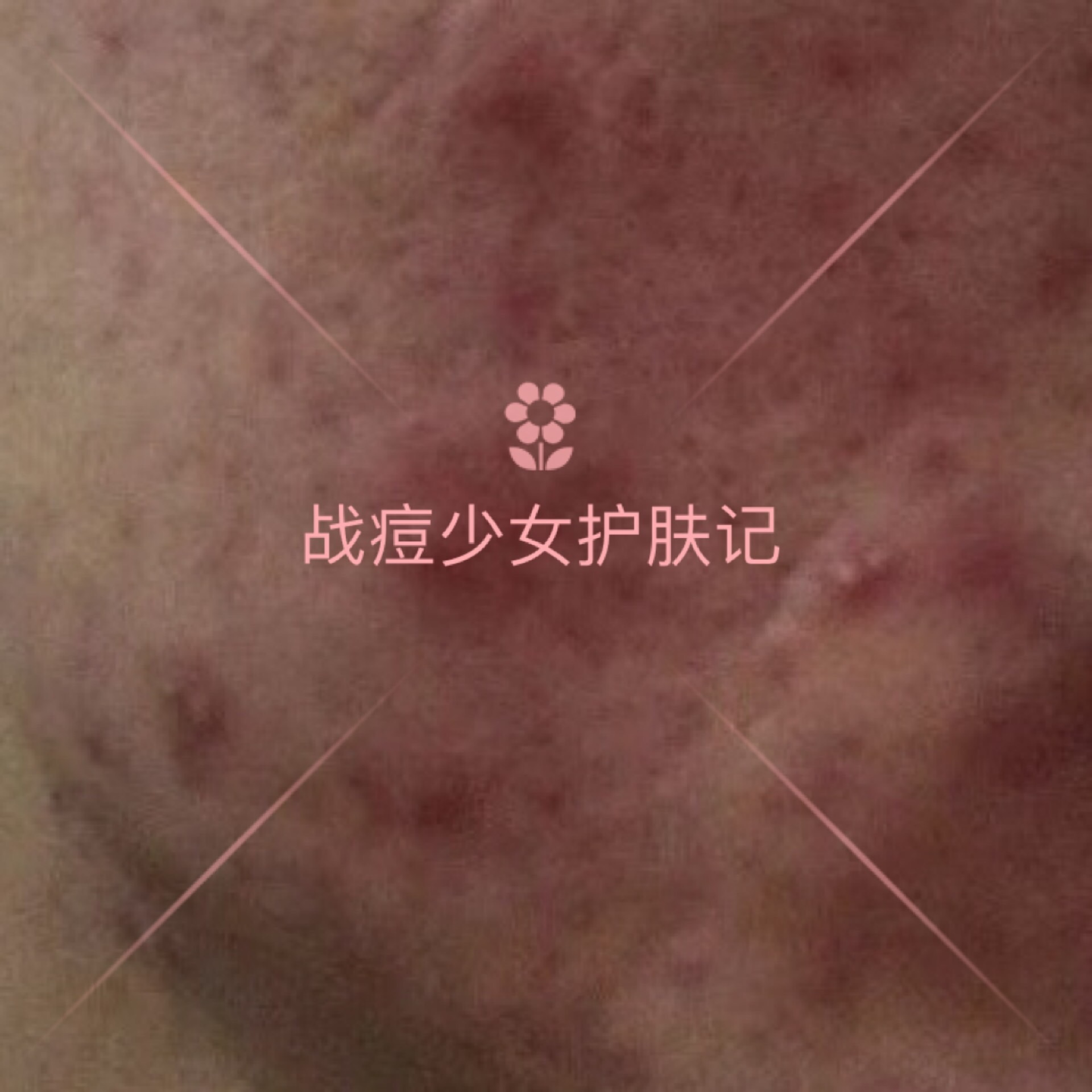 四招解决痘痘及痘痘的成因,痘痘不同原因类型及处理方法