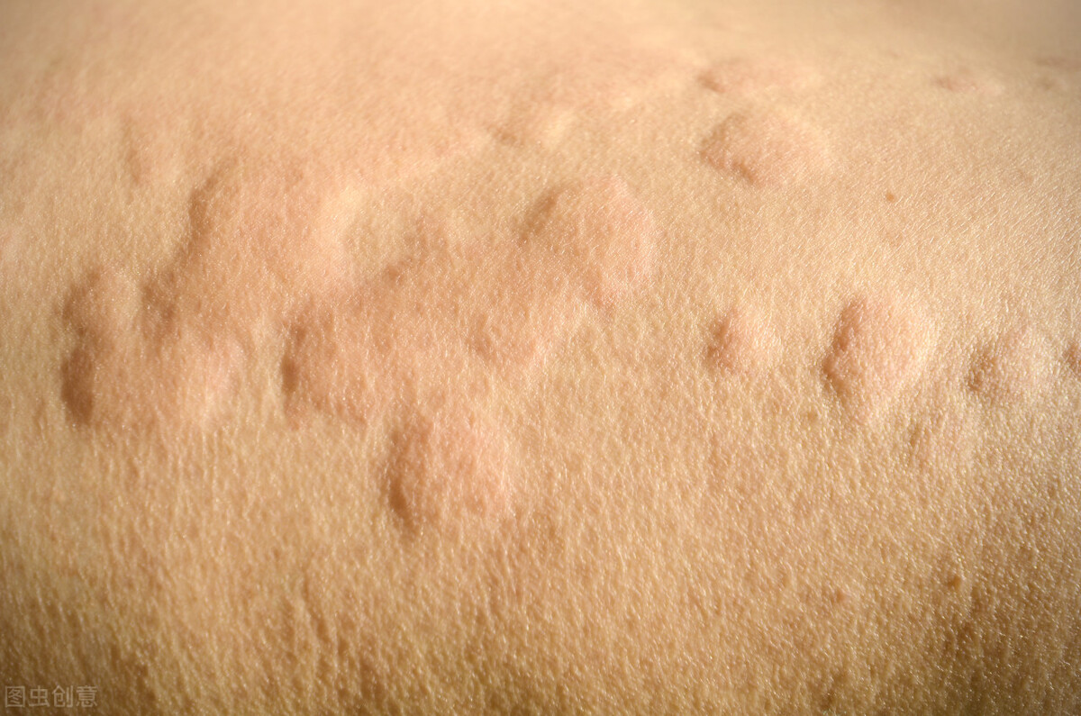 麻疹引起的原因,麻疹产生的原因