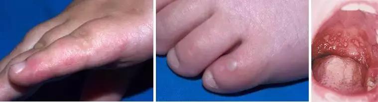 幼儿手足口病怎么传染的动画解说,手足口病儿童动画视频