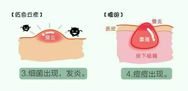 说说都如何治好痘痘的,一痘毁所有5个祛痘小技巧