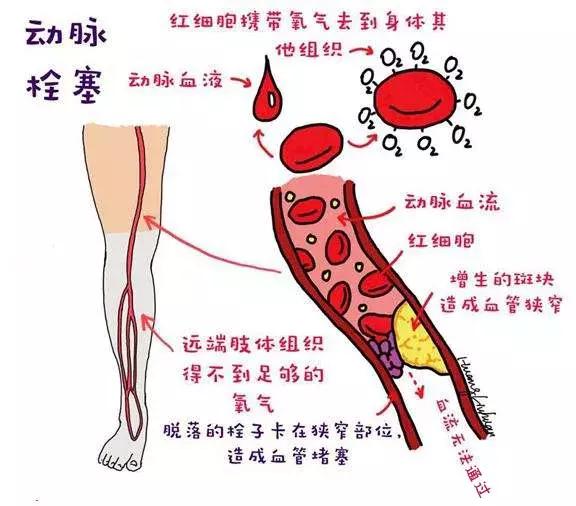 小腿血栓皮肤溃烂创面怎么处理,皮肤血管坏死怎么回事