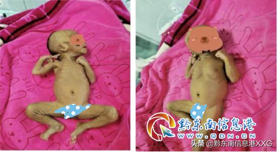 皮包骨变萌娃!丹寨县人民医院成功救治一名重度营养不良患儿