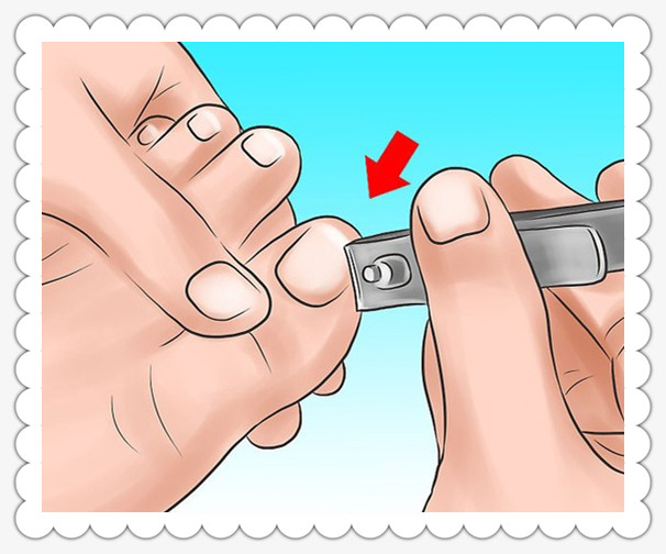 甲沟炎的处理方法视频,甲沟炎处理小视频