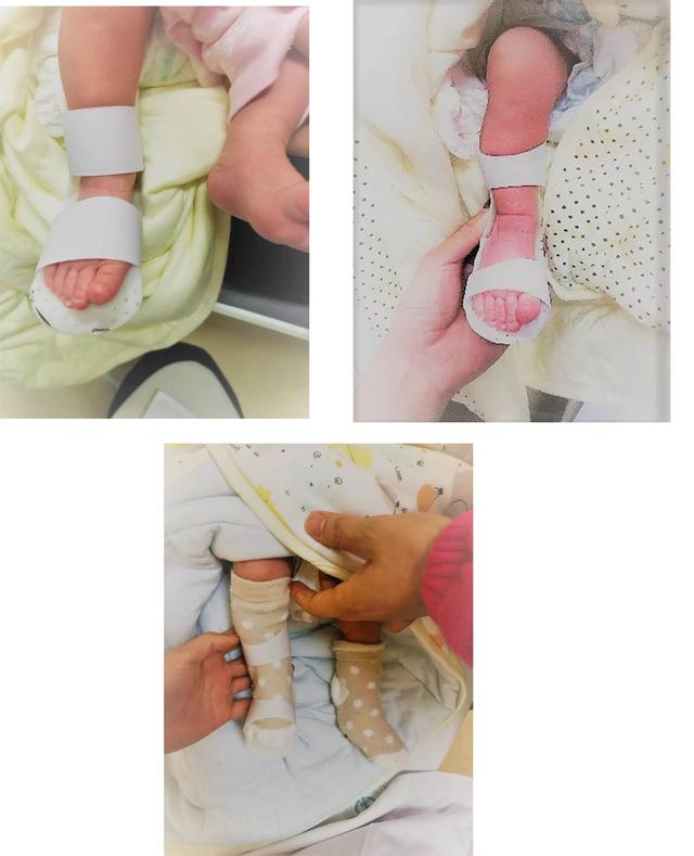 孩子足外翻与足内翻怎么办呢,足内翻和足外翻按摩什么穴位