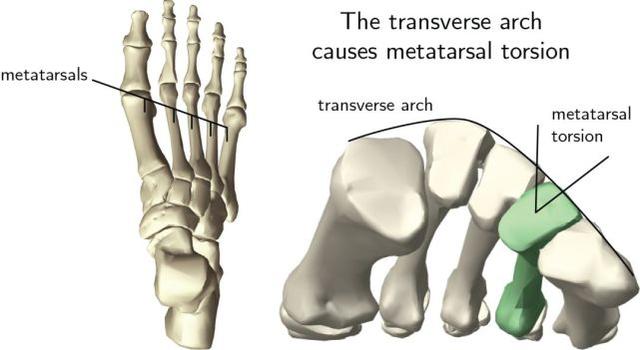 拇外翻导致的脚趾间老茧,拇外翻脚掌前面有茧