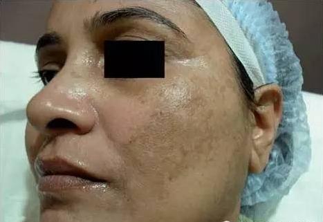 女生褐青斑是什么原因造成,女性为什么出现面色暗黄斑点增多