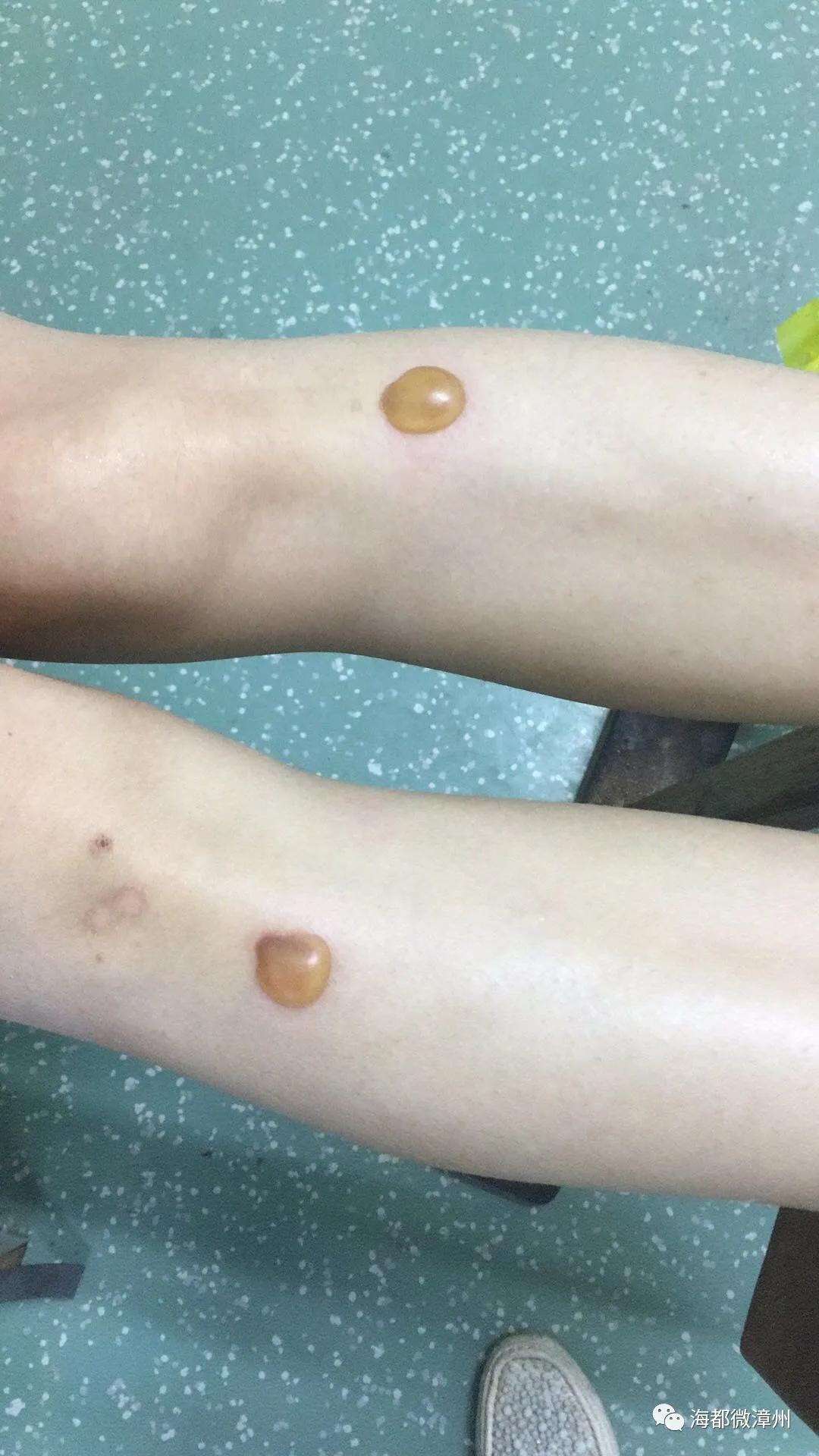 在医院艾灸被烫伤医院有没有责任,患者艾灸烫伤原因分析及整改措施