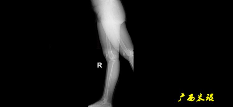 广西骨科医生米琨最新信息,米琨广西骨科什么水平
