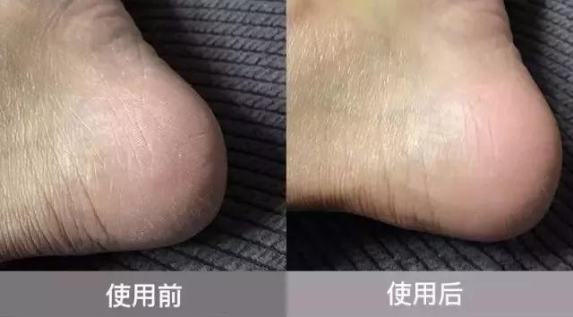 澳洲顶级护脚膏,凡士林手足防裂膏妈妈用