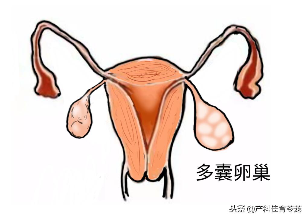 卵巢囊肿做了肿瘤标志物显示正常,卵巢囊肿内见密集光点正常吗