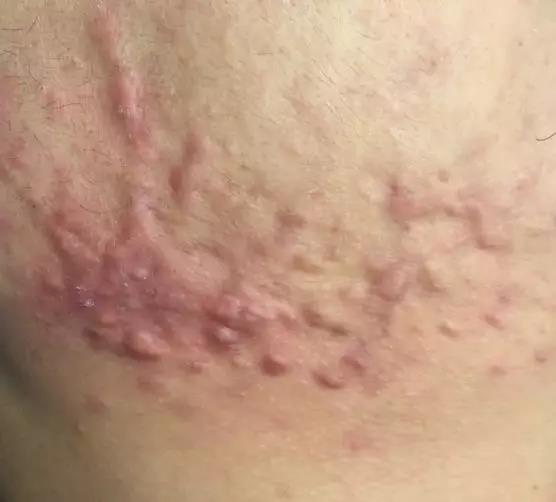 痘印淡化且不留痕迹方法男生,痘印有效去除