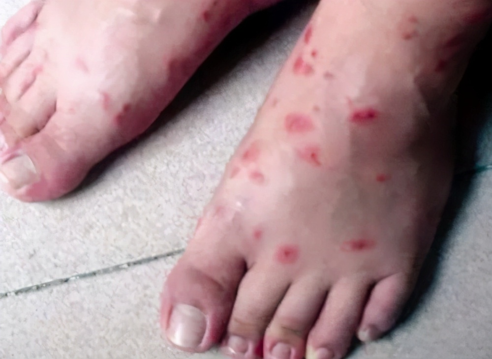 红火蚁目前传播到哪些省了,红火蚁对哪些疾病有传播